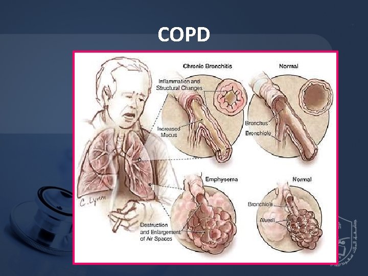 COPD 