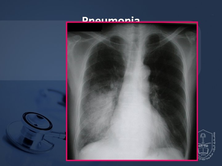 Pneumonia 