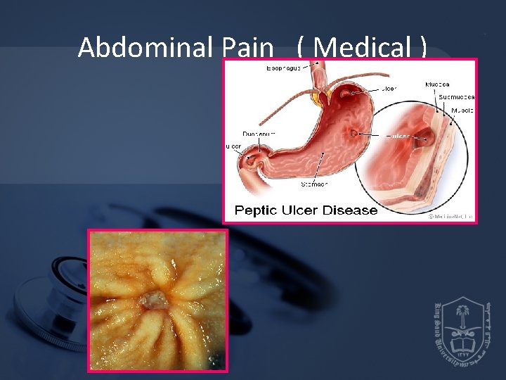 Abdominal Pain ( Medical ) 
