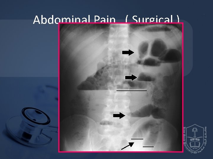 Abdominal Pain ( Surgical ) 