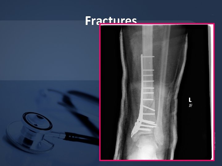 Fractures 
