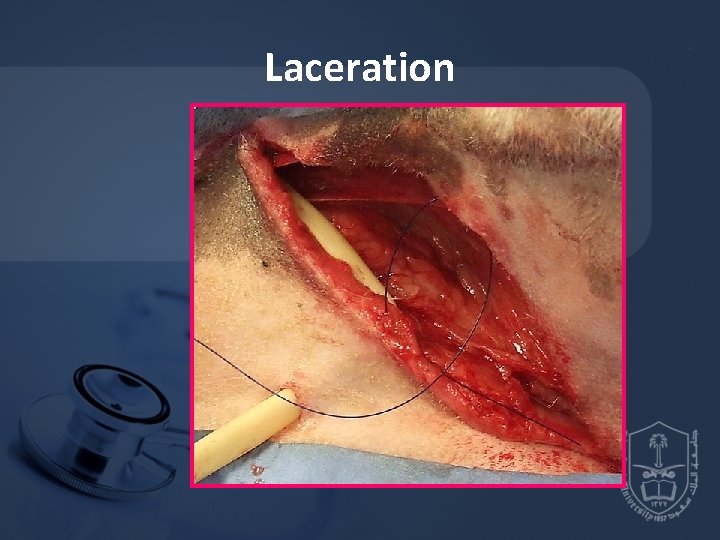 Laceration 