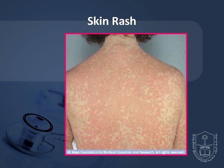 Skin Rash 