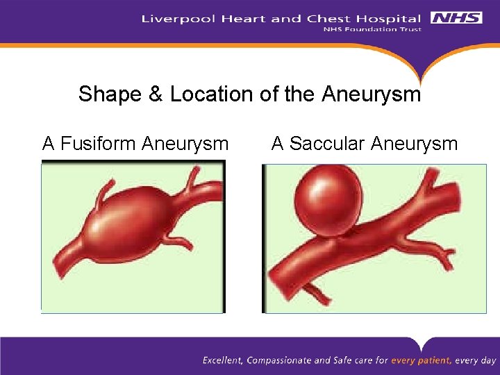 Shape & Location of the Aneurysm A Fusiform Aneurysm A Saccular Aneurysm 