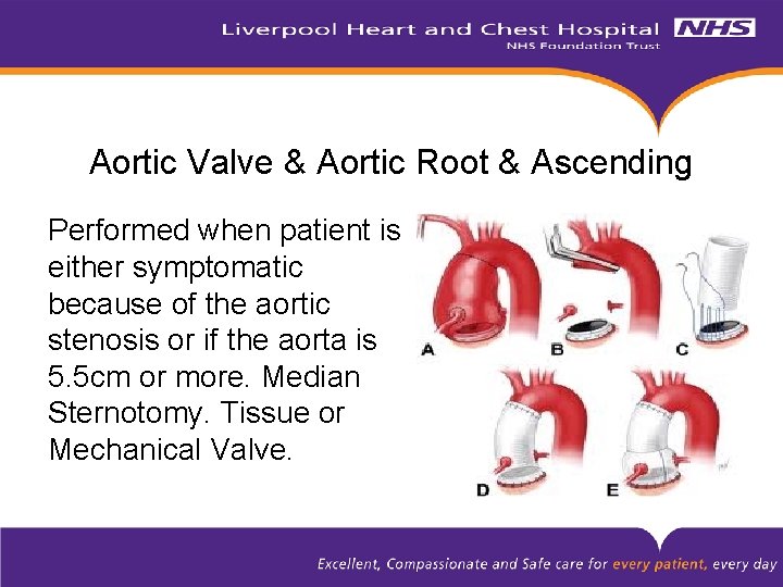 Aortic Valve & Aortic Root & Ascending Performed when patient is either symptomatic because