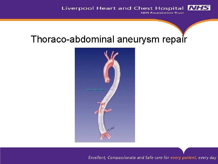 Thoraco-abdominal aneurysm repair 