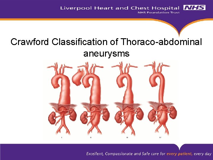 Crawford Classification of Thoraco-abdominal aneurysms 