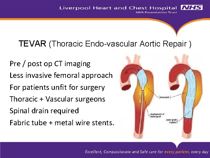 TEVAR (Thoracic Endo-vascular Aortic Repair ) Pre / post op CT imaging Less invasive