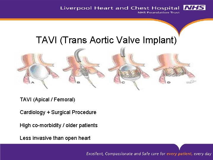 TAVI (Trans Aortic Valve Implant) TAVI (Apical / Femoral) Cardiology + Surgical Procedure High