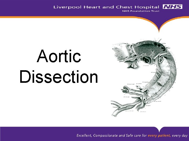 Aortic Dissection 