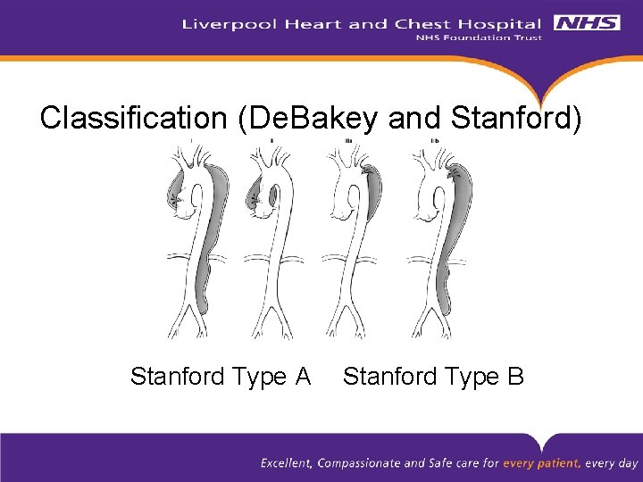 Classification (De. Bakey and Stanford) Stanford Type A Stanford Type B 