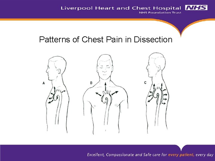 Patterns of Chest Pain in Dissection 