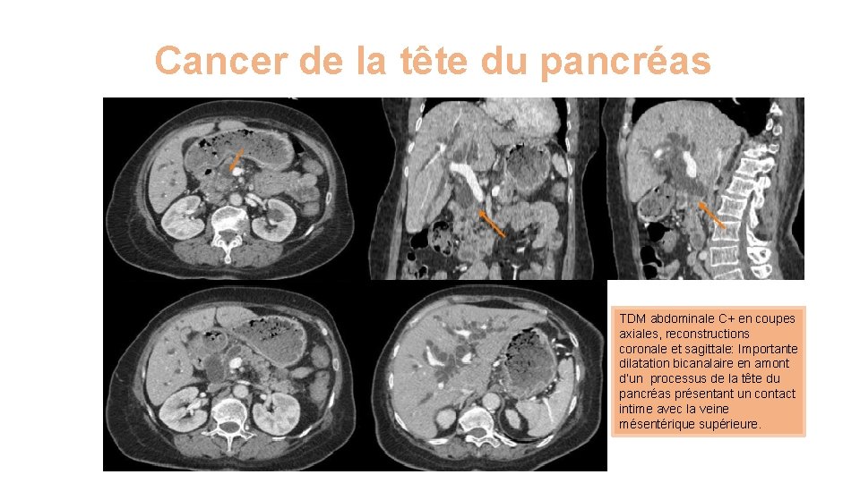 Cancer de la tête du pancréas TDM abdominale C+ en coupes axiales, reconstructions coronale