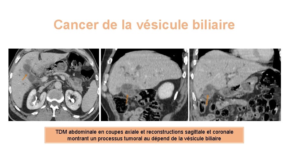 Cancer de la vésicule biliaire TDM abdominale en coupes axiale et reconstructions sagittale et