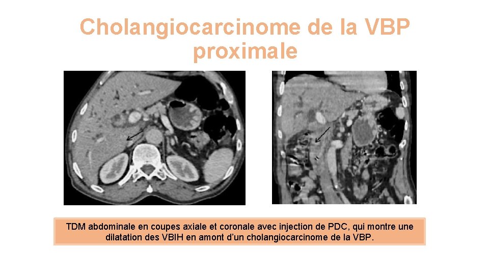 Cholangiocarcinome de la VBP proximale TDM abdominale en coupes axiale et coronale avec injection