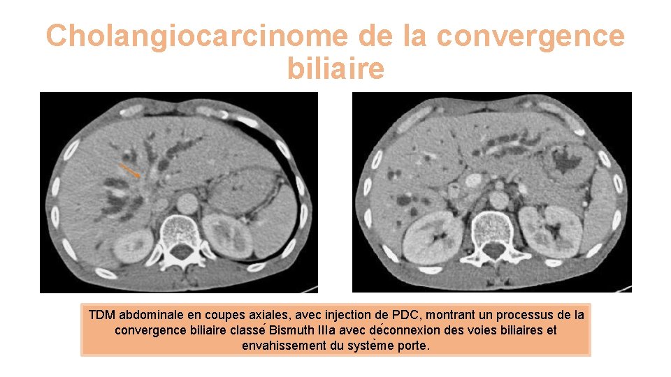 Cholangiocarcinome de la convergence biliaire TDM abdominale en coupes axiales, avec injection de PDC,
