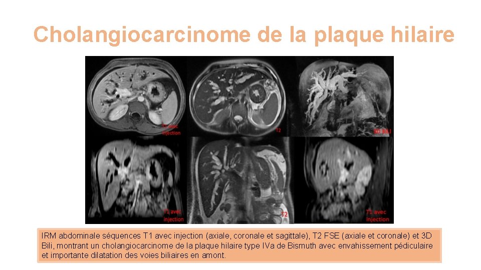 Cholangiocarcinome de la plaque hilaire IRM abdominale séquences T 1 avec injection (axiale, coronale