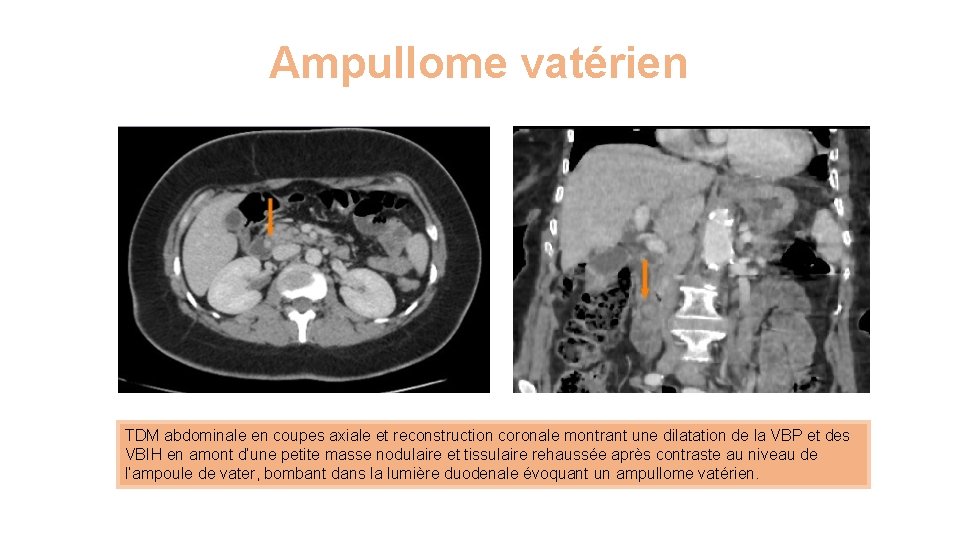 Ampullome vatérien TDM abdominale en coupes axiale et reconstruction coronale montrant une dilatation de