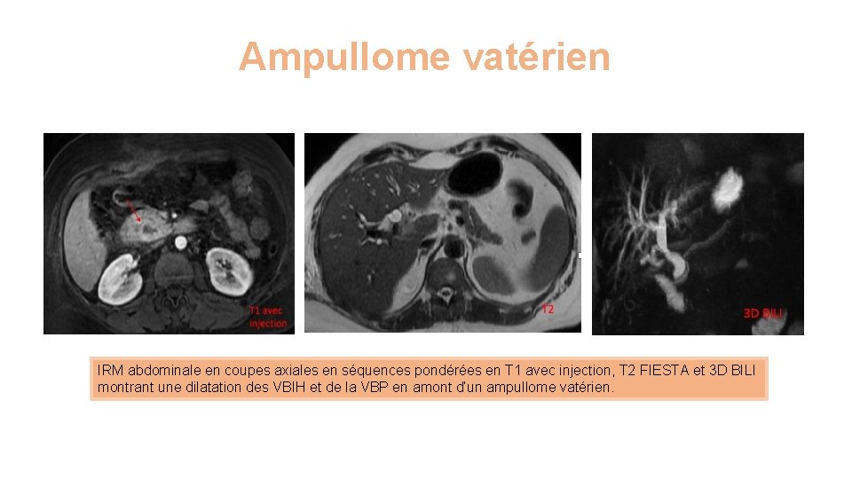 Ampullome vatérien IRM abdominale en coupes axiales en séquences pondérées en T 1 avec