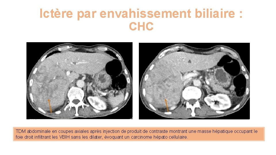 Ictère par envahissement biliaire : CHC TDM abdominale en coupes axiales après injection de
