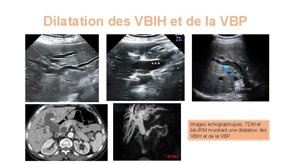 Dilatation des VBIH et de la VBP Images échographiques, TDM et bili-IRM montrant une