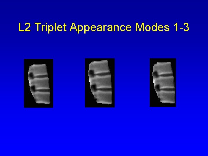 L 2 Triplet Appearance Modes 1 -3 