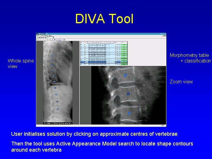 DIVA Tool Whole spine view Morphometry table + classification Zoom view User initialises solution