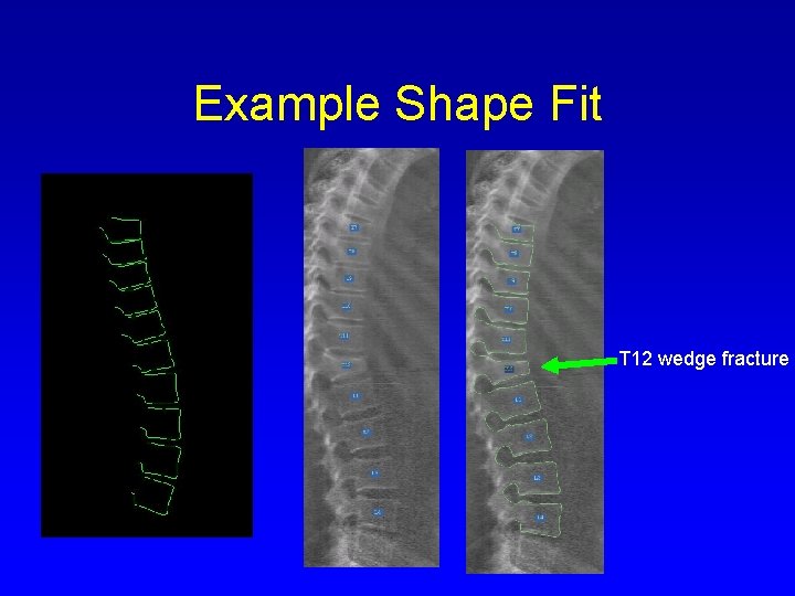Example Shape Fit T 12 wedge fracture 