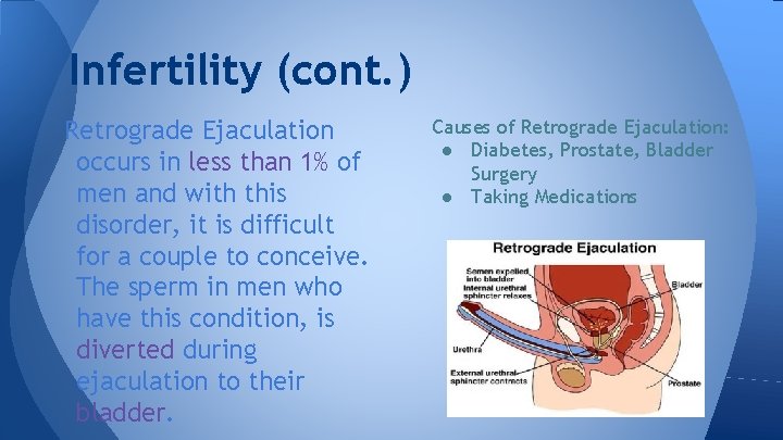 Infertility (cont. ) Retrograde Ejaculation occurs in less than 1% of men and with