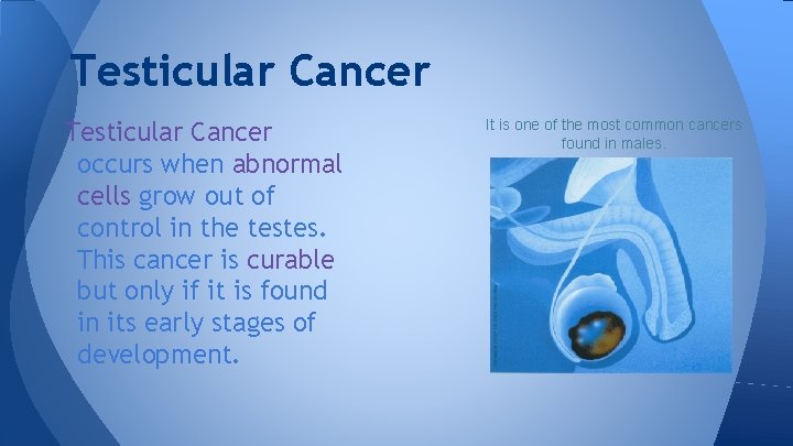 Testicular Cancer occurs when abnormal cells grow out of control in the testes. This