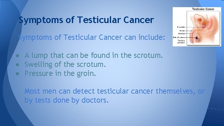 Symptoms of Testicular Cancer can include: ● A lump that can be found in
