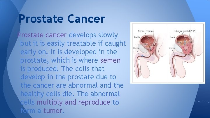 Prostate Cancer Prostate cancer develops slowly but it is easily treatable if caught early