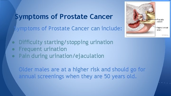 Symptoms of Prostate Cancer can include: ● Difficulty starting/stopping urination ● Frequent urination ●