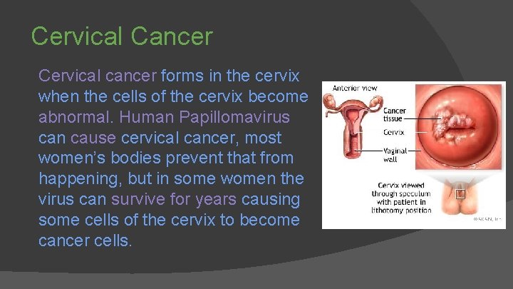 Cervical Cancer Cervical cancer forms in the cervix when the cells of the cervix