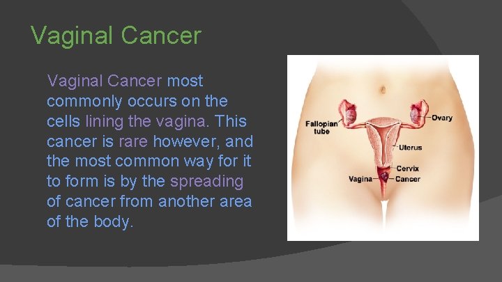 Vaginal Cancer most commonly occurs on the cells lining the vagina. This cancer is