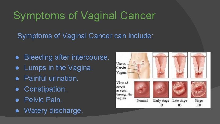 Symptoms of Vaginal Cancer can include: ● ● ● Bleeding after intercourse. Lumps in