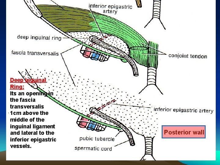 Deep Inguinal Ring: Its an opening in the fascia transversalis 1 cm above the