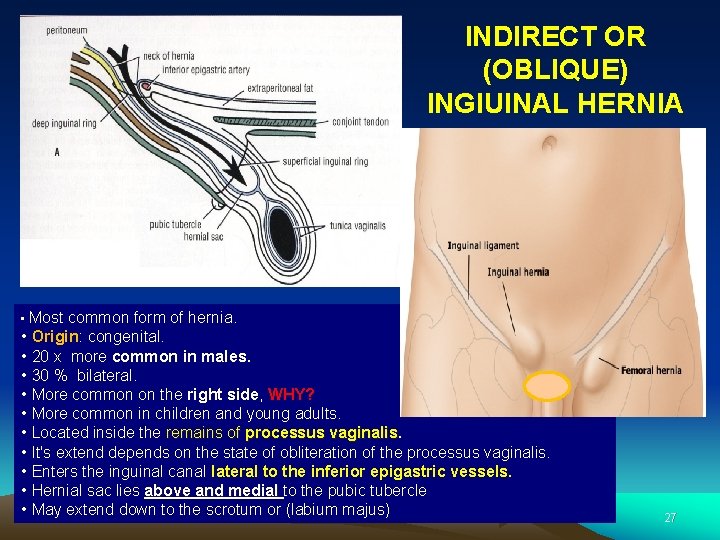 INDIRECT OR (OBLIQUE) INGIUINAL HERNIA • Most common form of hernia. • Origin: congenital.