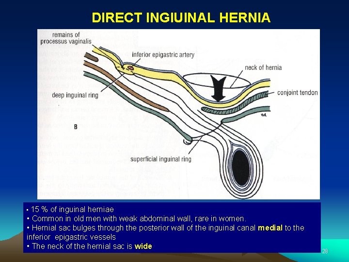 DIRECT INGIUINAL HERNIA • 15 % of inguinal herniae • Common in old men