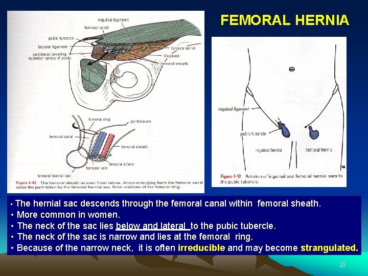 FEMORAL HERNIA • The hernial sac descends through the femoral canal within femoral sheath.