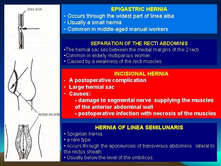 EPIGASTRIC HERNIA • Occurs through the widest part of linea alba • Usually a