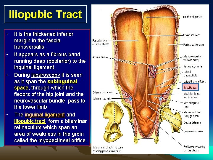 Iliopubic Tract • • It is the thickened inferior margin in the fascia transversalis.