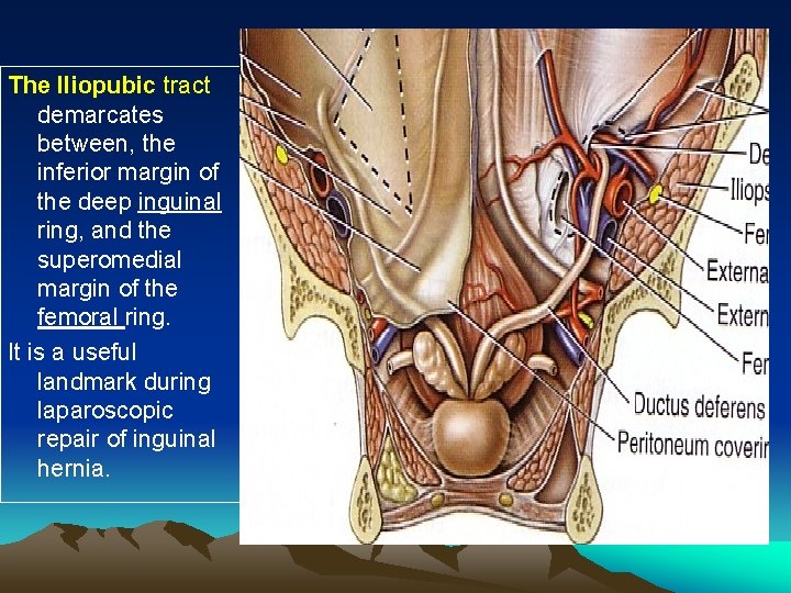 The Iliopubic tract demarcates between, the inferior margin of the deep inguinal ring, and