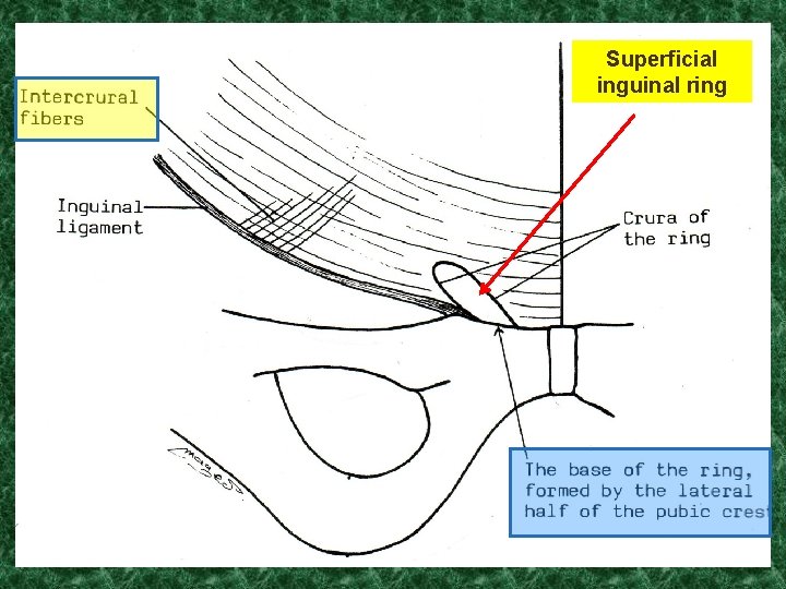 Layers of the Anterior Superficial Abdominal Wall inguinal ring 1 - Skin. 2 -