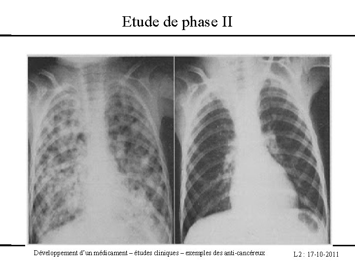 Etude de phase II Développement d’un médicament – études cliniques – exemples des anti-cancéreux