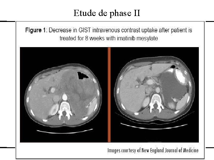 Etude de phase II Développement d’un médicament – études cliniques – exemples des anti-cancéreux