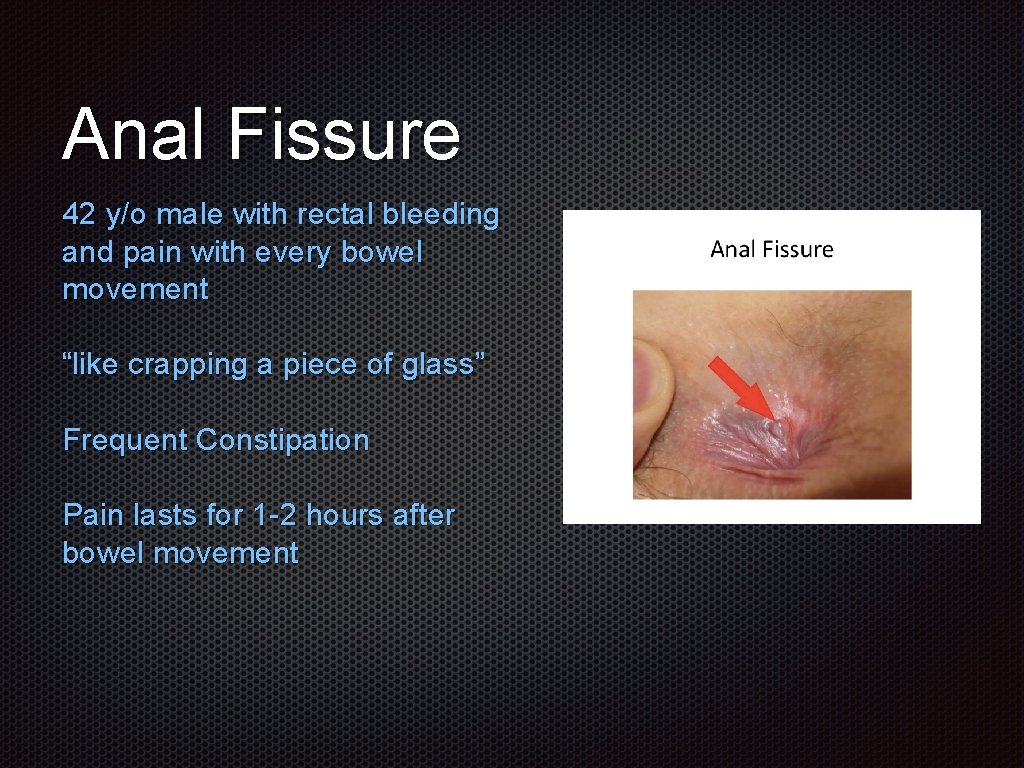 Anal Fissure 42 y/o male with rectal bleeding and pain with every bowel movement