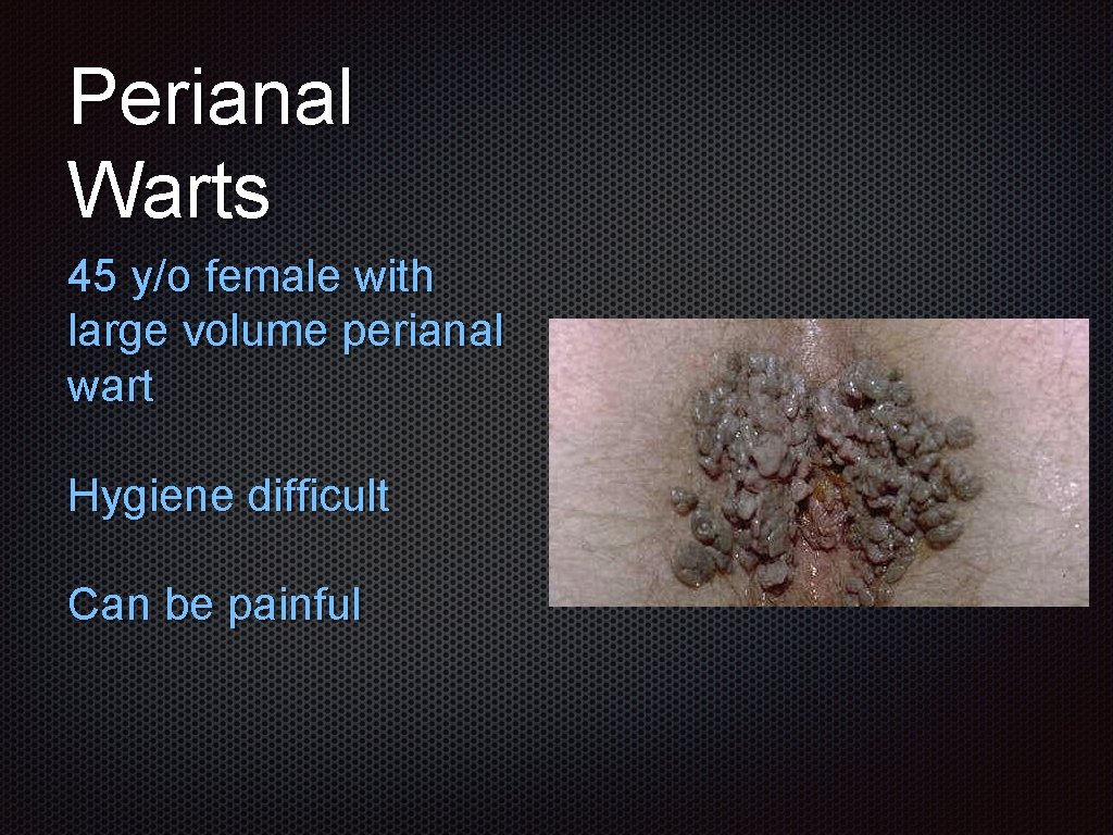 Perianal Warts 45 y/o female with large volume perianal wart Hygiene difficult Can be