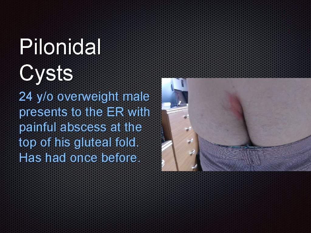 Pilonidal Cysts 24 y/o overweight male presents to the ER with painful abscess at