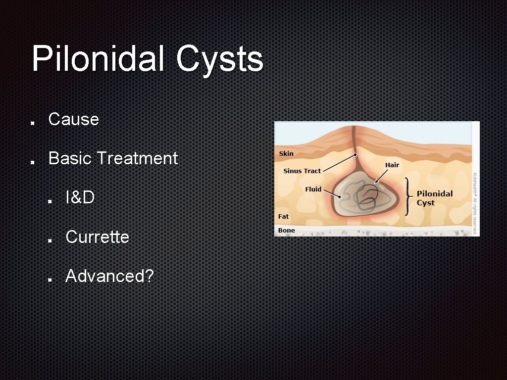Pilonidal Cysts Cause Basic Treatment I&D Currette Advanced? 